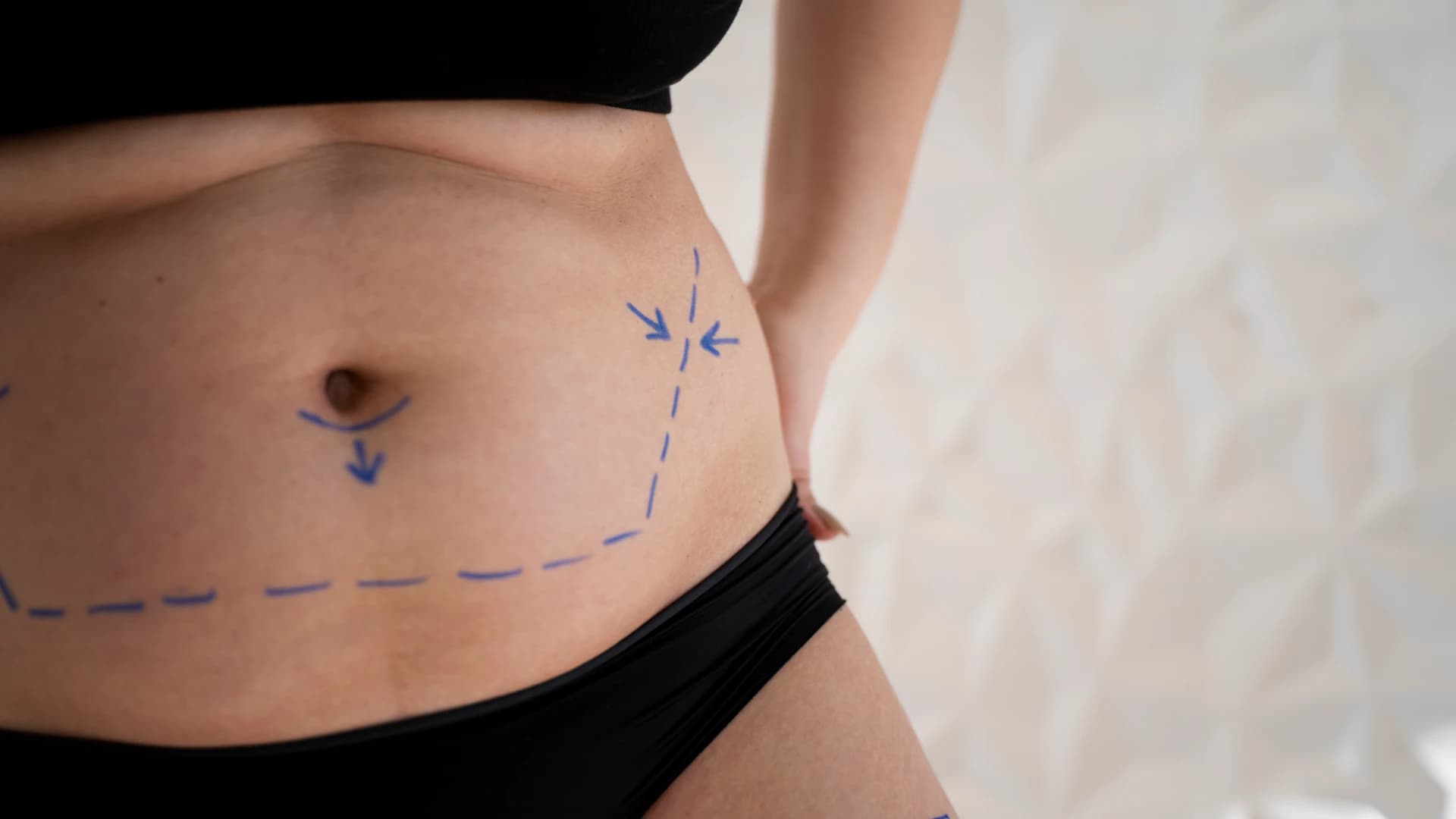 Quando a Cirurgia Bariátrica é Indicada: Critérios e IMC